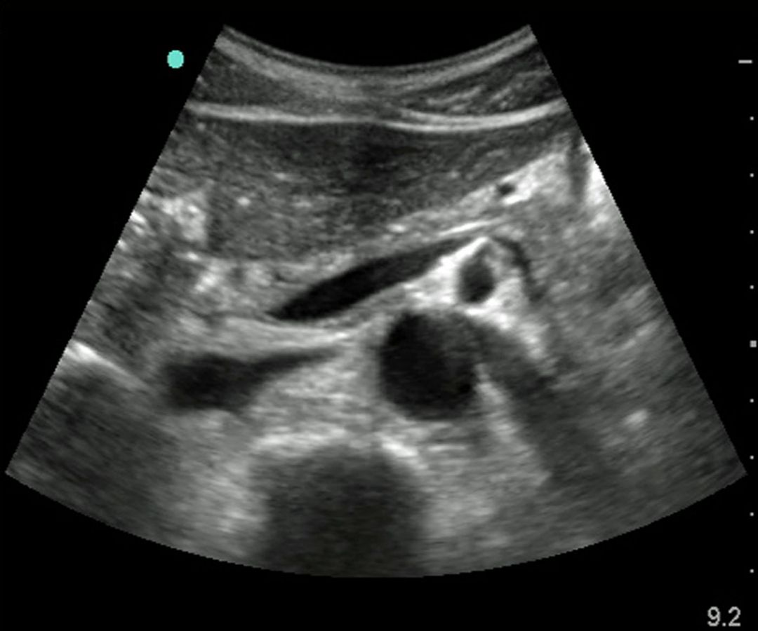 ultrasound of the aorta