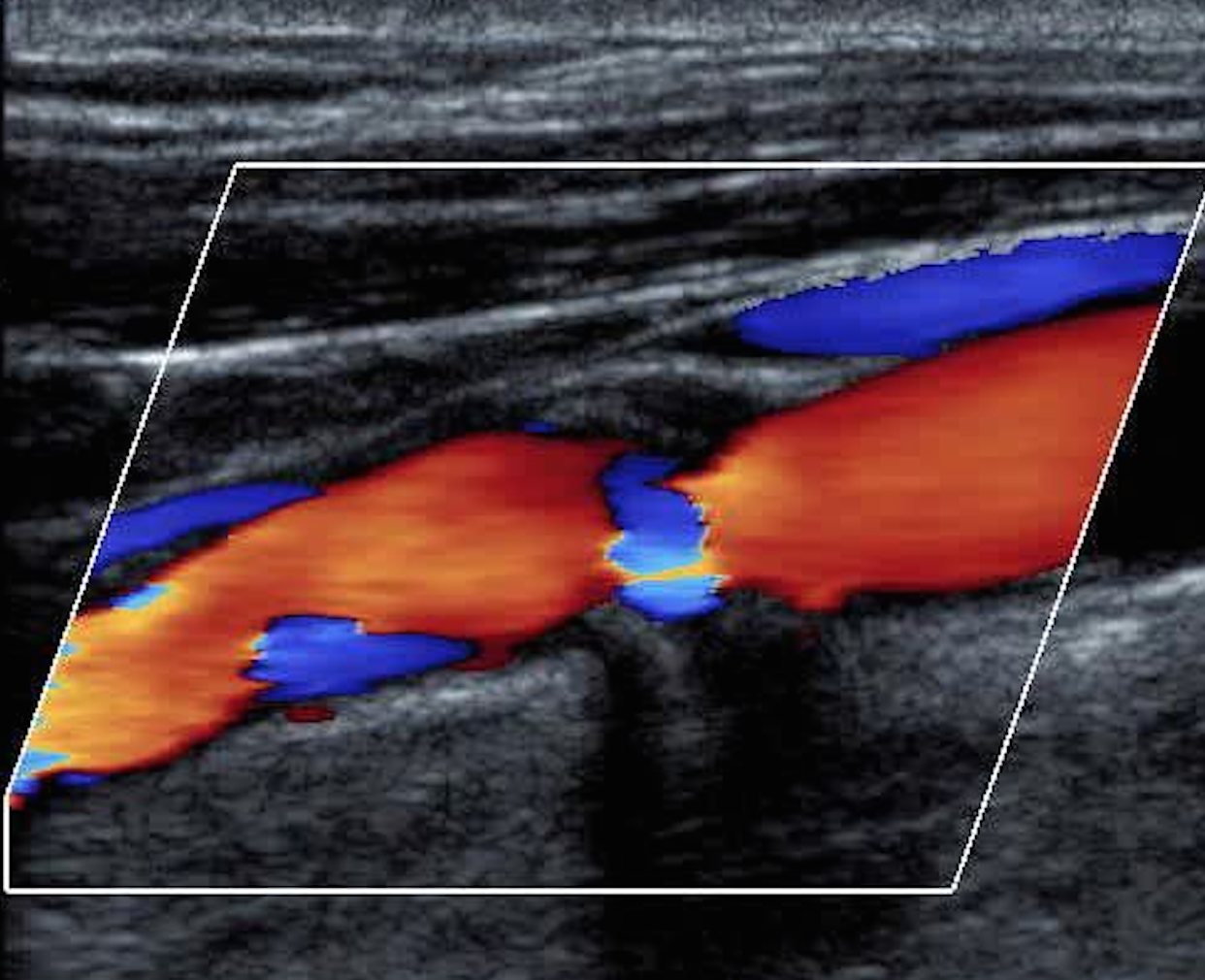 Vascular ultrasound