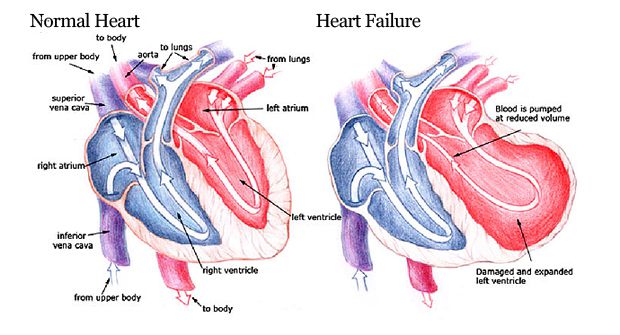 Congestive Heart Failure